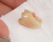 An extracted 3rd molar that was horizontally impacted