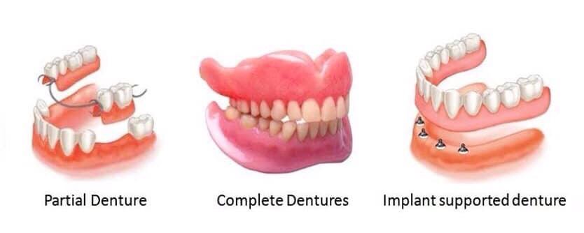 dentures Image